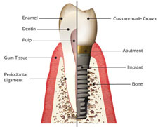 Зубные имплантанты
